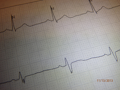 Ранняя диагностика инфаркта миокарда