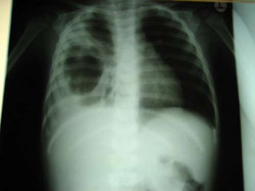 рентген легких при Ковид-19