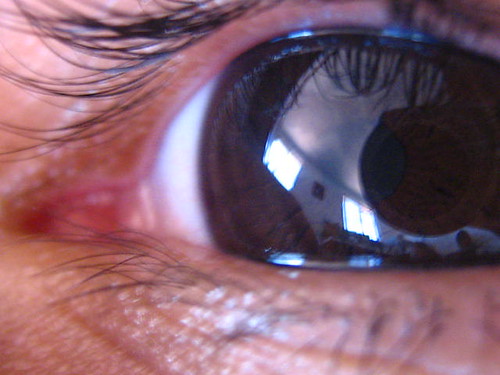 Симптомы глаукомы на ранней стадии