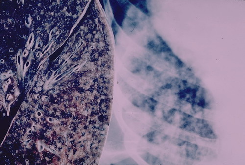 меры профилактики туберкулеза легких